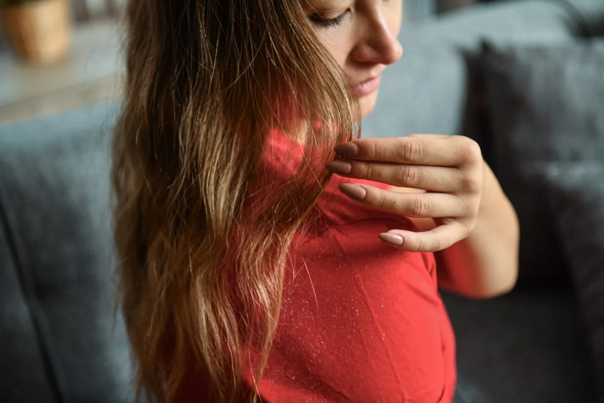 Dandruff and Seborrheic Dermatitis: Symptoms, Causes and Treatment